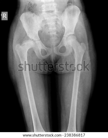 x-ray of child hip