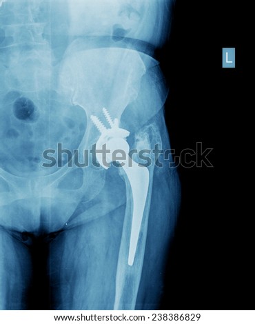 X-ray of the hip prosthesis