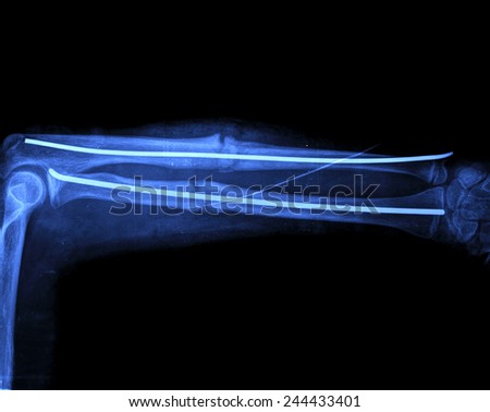 x ray of broken arm with screw