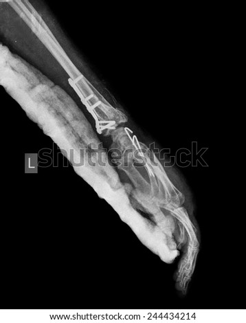 xray of broken arm in cast