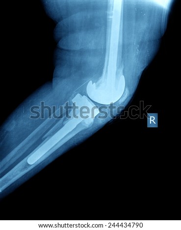 x ray of knee prosthesis