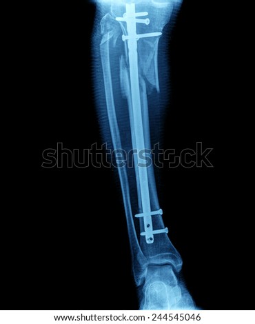 X ray of broken leg with screw