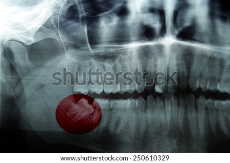 X-ray, panoramic  RTG , radiology, photo showing skew wisdom tooth (eight tooth) for removal