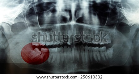 RTG, x-ray, radiology photo of wisdom (eight) tooth.