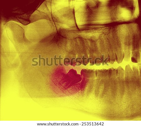 X-ray, panoramic RTG , radiology, photo showing skew wisdom tooth (eight tooth) for removal - yellow and brown effect