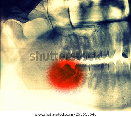 X-ray, panoramic RTG , radiology, photo showing skew wisdom tooth (eight tooth) for removal - instagram effect