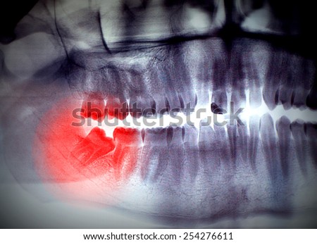 X-ray, panoramic RTG , radiology, photo showing skew wisdom tooth (eight tooth) for removal - black and white