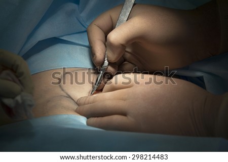 scalpel in surgeon\'s hand before the surgical incision