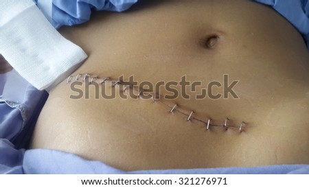 surgical suture.