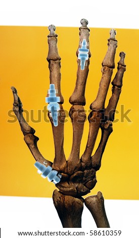 Artificial implants in human hand. (Finger Joint Replacement Surgery)