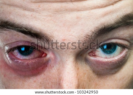 Close up shot of black eye on man face