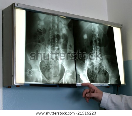 kidneys x-ray in a x-ray lab exposed