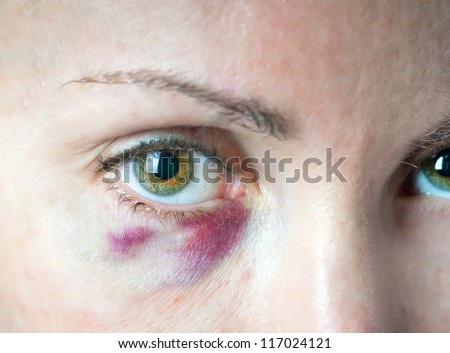 bruise under an eye. Cosmetology. The prick got to a vessels