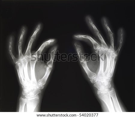 X-ray of both human hands in pinching position, space for copy