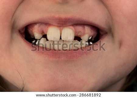 Young female child\'s teeth, image shows missing baby teeth and the start of the adult teeth coming through the gums, also shows metal crowns on the rear teeth