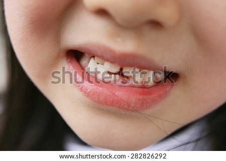 Close-up of a little girl losing two lower milk teeth and a permanent tooth in the shape of a tulip coming in.