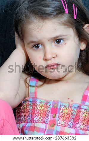 Little girl with varicella, chicken pox, small pox.