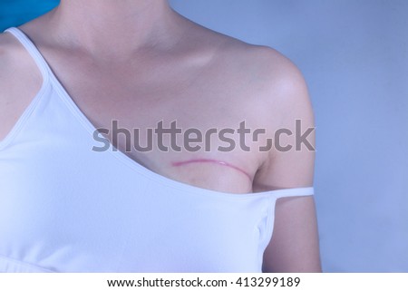Breast cancer surgery scars by partial mastectomy. With effect filter.