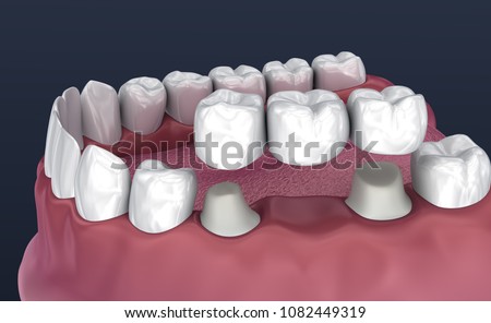 Tooth supported fixed bridge of 3 teeth. Medically accurate 3D illustration