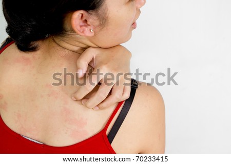 heat rashes pictures. heat rash on arms. a heat rash