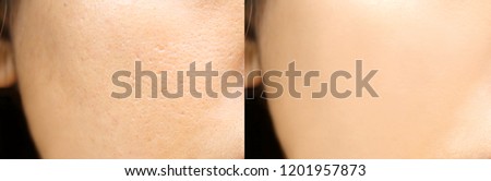 Compare before and after (retouch photo) of close up wide pores skin on oily face have pimple of asia woman