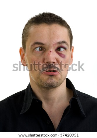 broken nose black eyes. stock photo : man with roken,