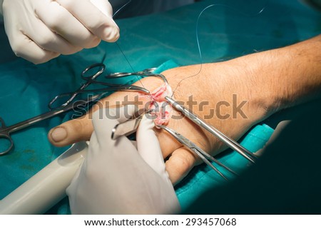 Hand surgery in operation room