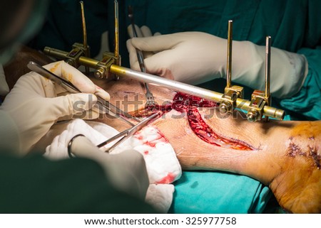 Hand surgery ORIF with Plate