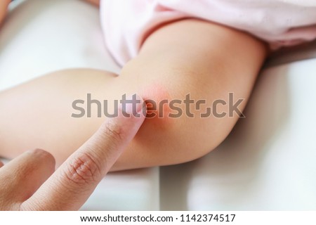 mother applying antiallergic cream at baby knee with skin rash and allergy with red spot cause by mosquito bite
