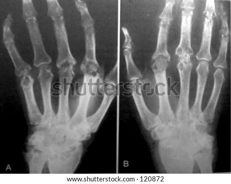 stock photo : X- ray of hands