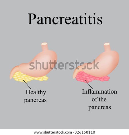 pancreas inflammation symptoms