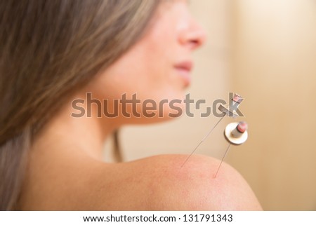 moxibustion acupunture needles heat on woman shoulder closeup