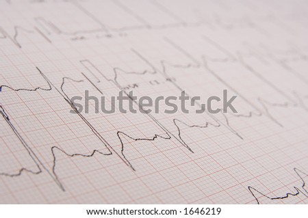 A medical printout from an ecg machine measuring heart activity