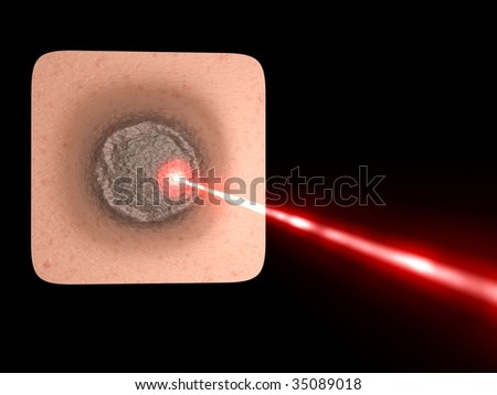 laser medical