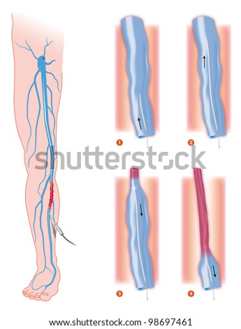 endovenous laser treatment varicose vein ablation endovenous laser treatment varicose vein ablation