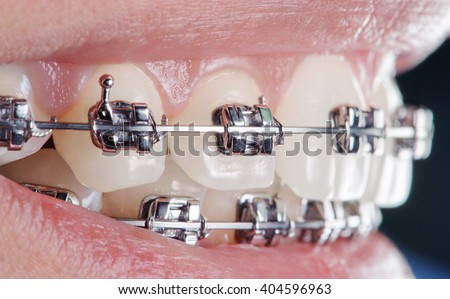 Close-up dental braces on teeth. Orthodontic Treatment. Dental care Concept. Extreme macro.