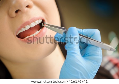 Smiling female patient with ceramic brackets at the dental office. Dentist holding reverse tweezers. Orthodontic Treatment.