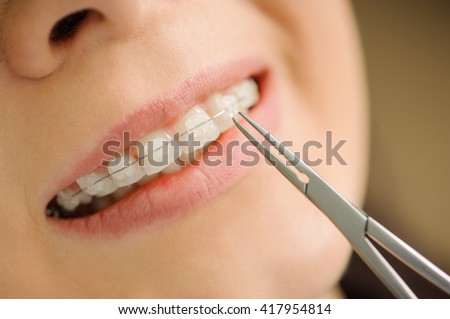 Close-up ceramic braces on teeth at the dental clinic. Dentist holding dental tool. Orthodontic Treatment.