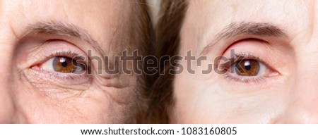 wrinkles under eye before and after botox treatment