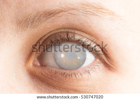 Eye with cataract and corneal opacification