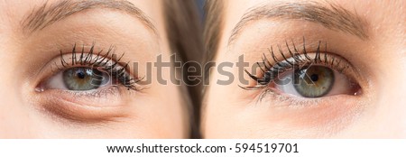 Before and after a blepharoplasty