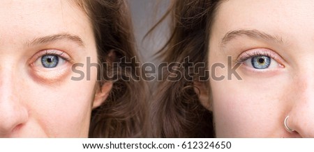Eyes before and after beauty treatment with and without wrinkles