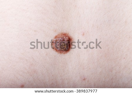 a large mole on a woman\'s body, close-up, medicine, health