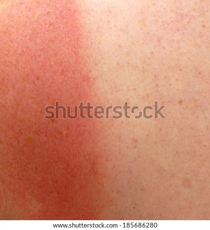 red sun burnt skin