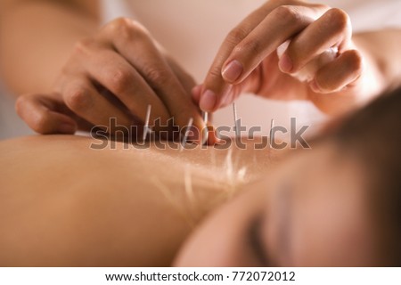 The doctor sticks needles into the girl\'s body on the acupuncture