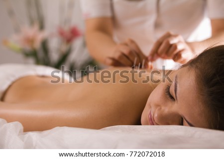 The doctor sticks needles into the woman\'s body on the acupuncture - close up