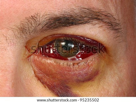 Detached Retina Surgery