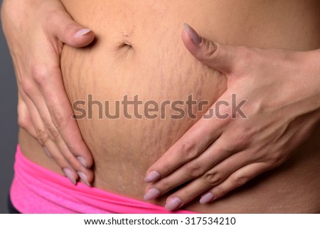 Woman showing stretch marks on her lower abdomen following child birth caused by the tearing of the dermis layer of the skin