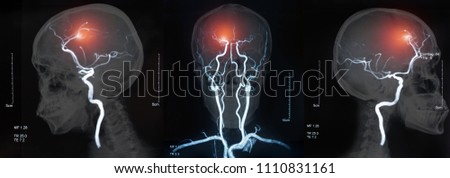 MRI of the blood vessels in the brain and cerebrovascular disease or or hemorrhagic stroke. brain stroke x-ray image.