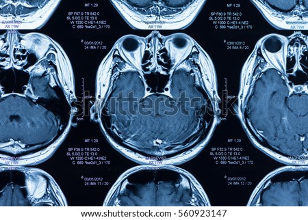 magnetic resonance image, mri scan of the brain.